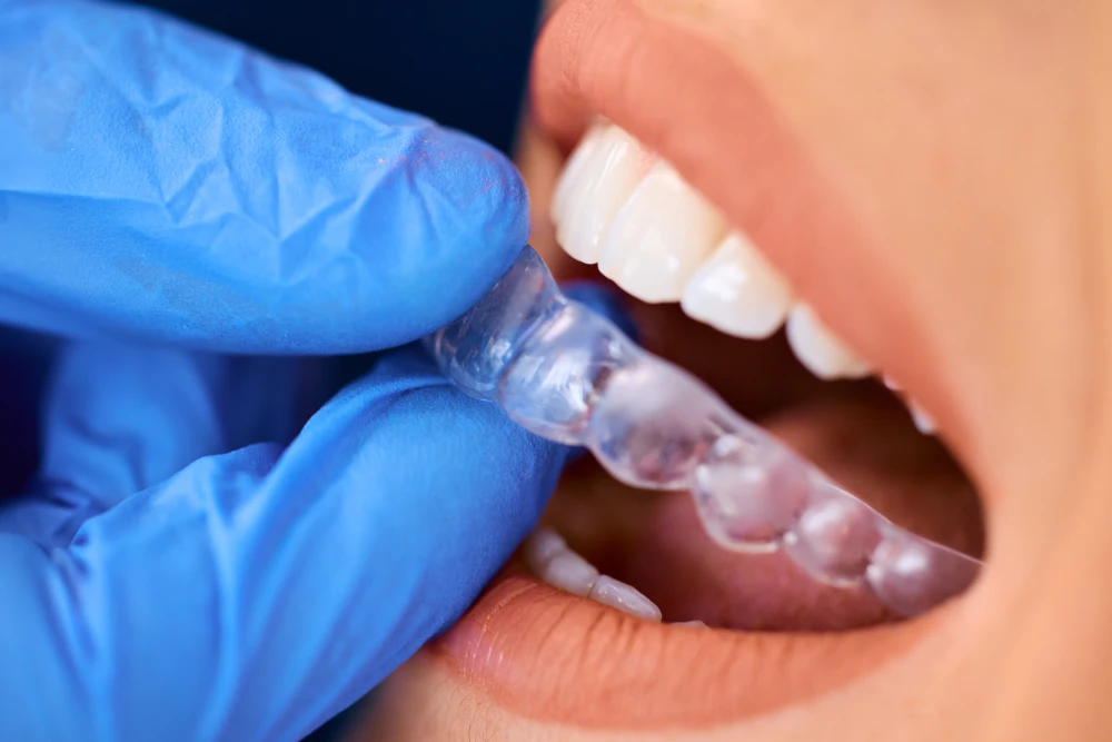 Invisalign clear aligners Miami Beach