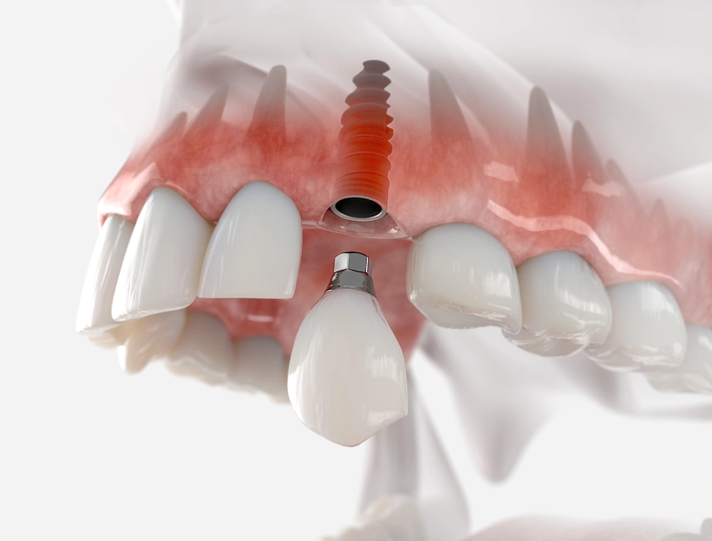 Dental implants Miami Beach