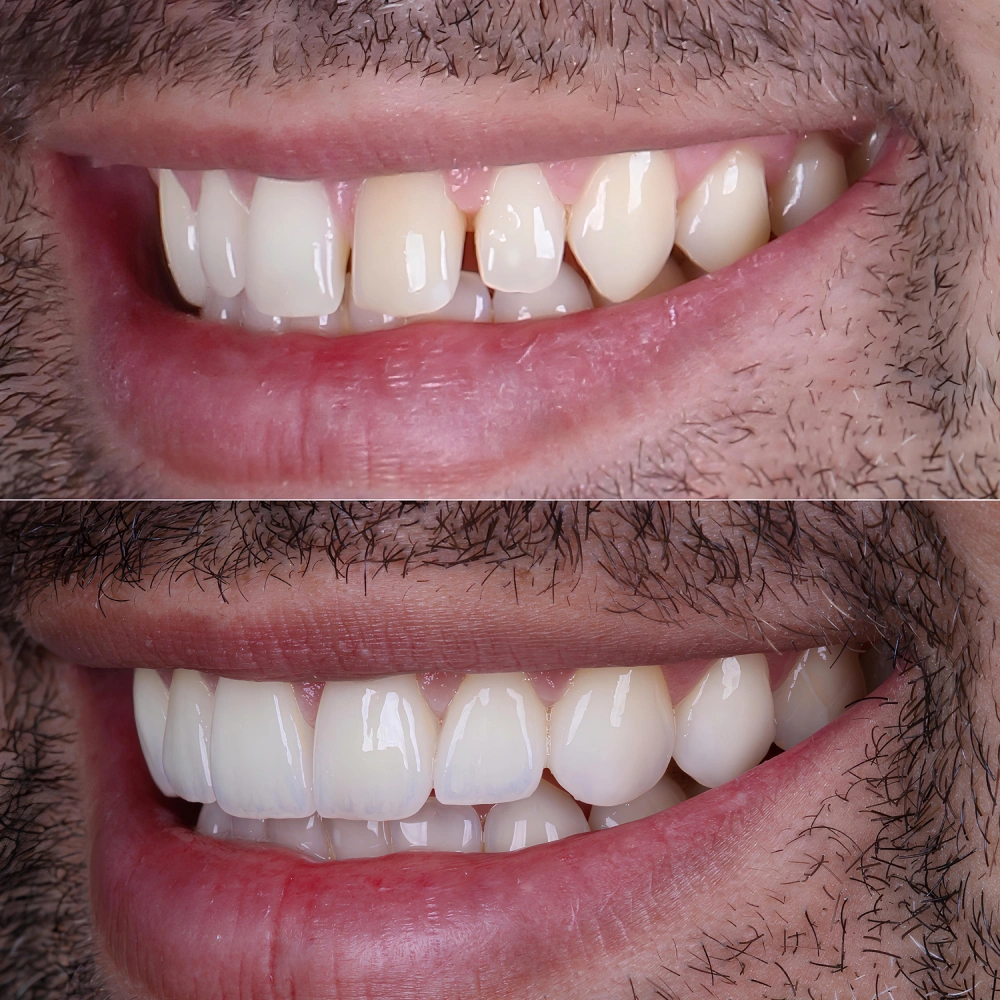 Porcelain veneers Miami Beach