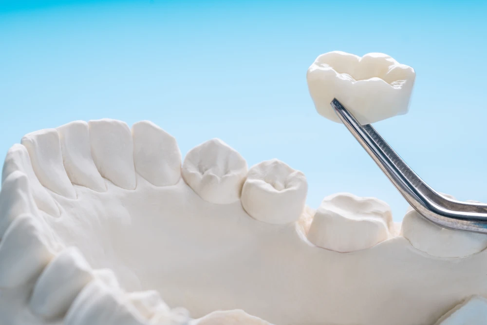 Dental crowns Miami Beach