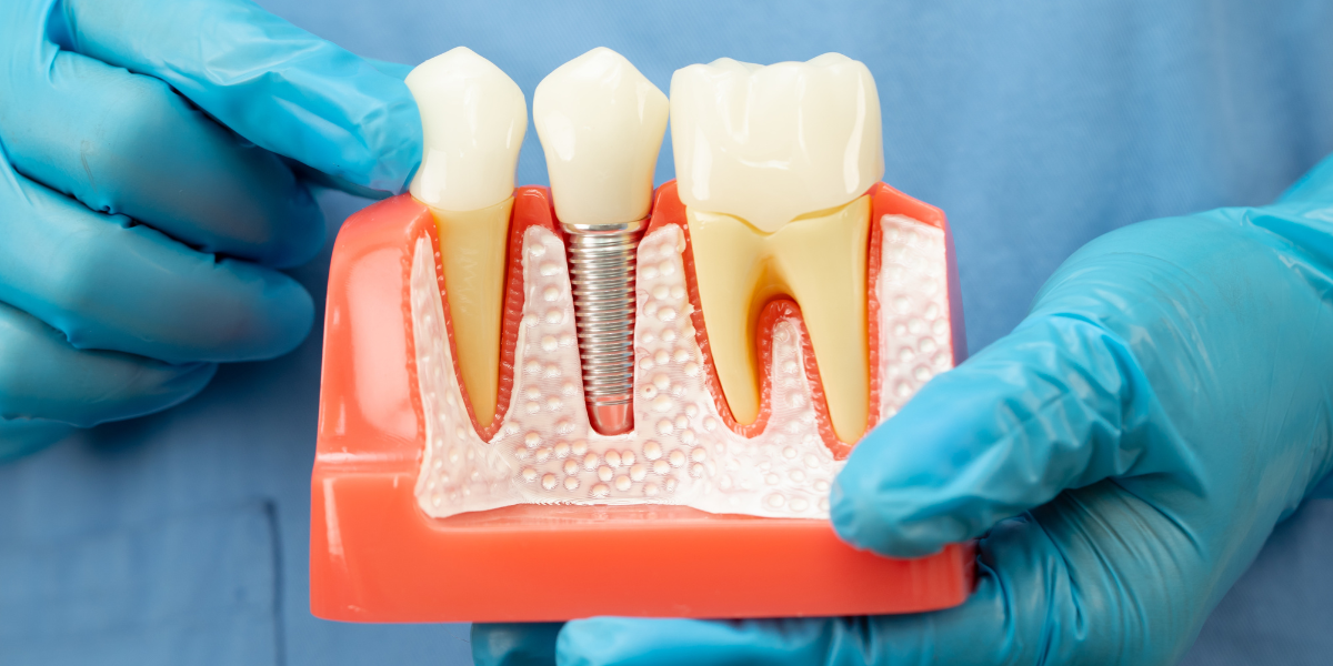 Can I Still Get a Dental Implant With Low Bone Density?
