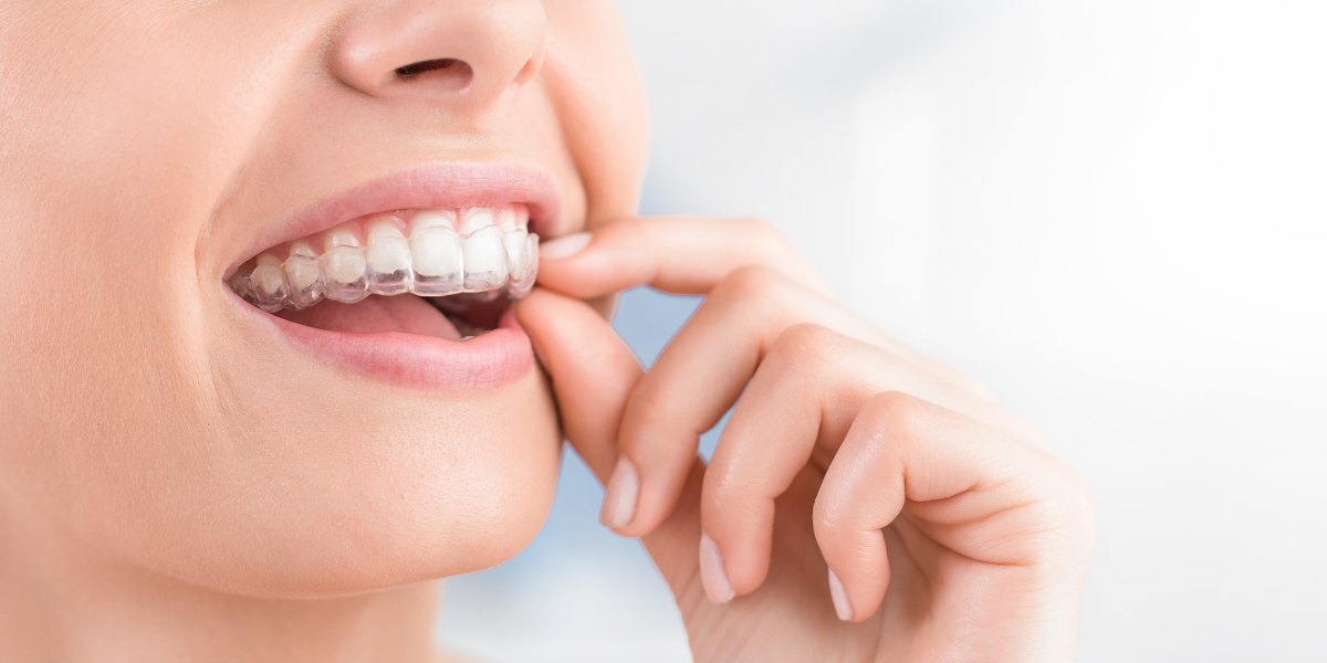 Can You Get Invisalign After Braces? What Most People Don't Know