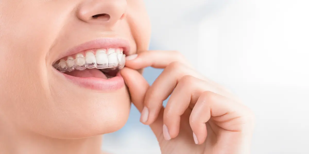 Can You Get Invisalign After Braces? What Most People Don't Know