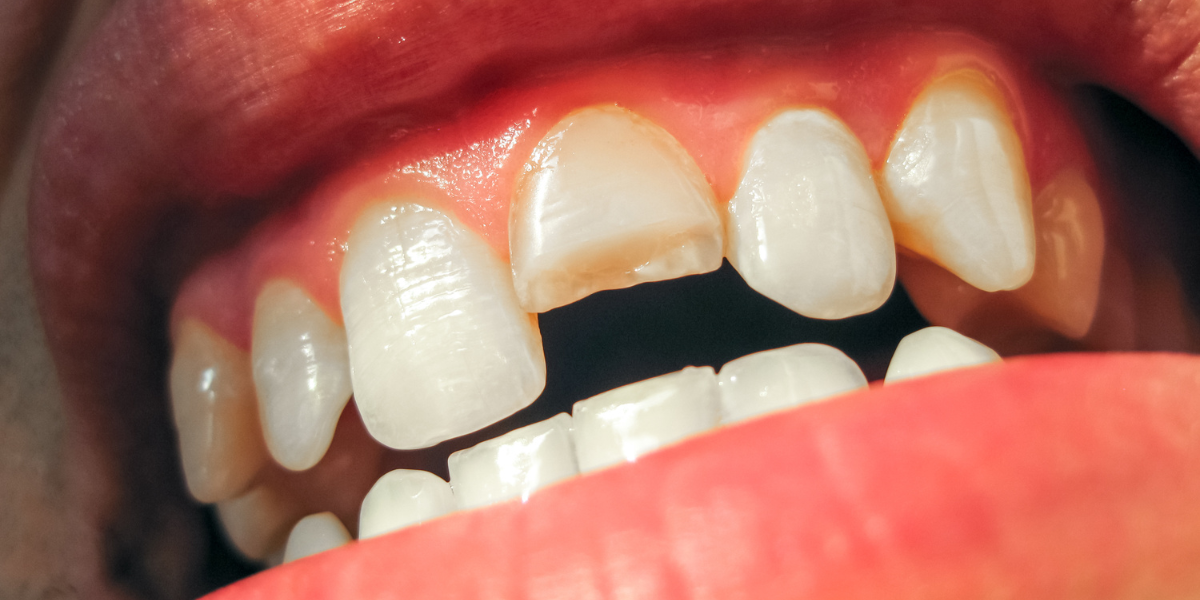Tooth Cracked in Miami Beach? When a Crown Saves It (and When It's Too Late)
