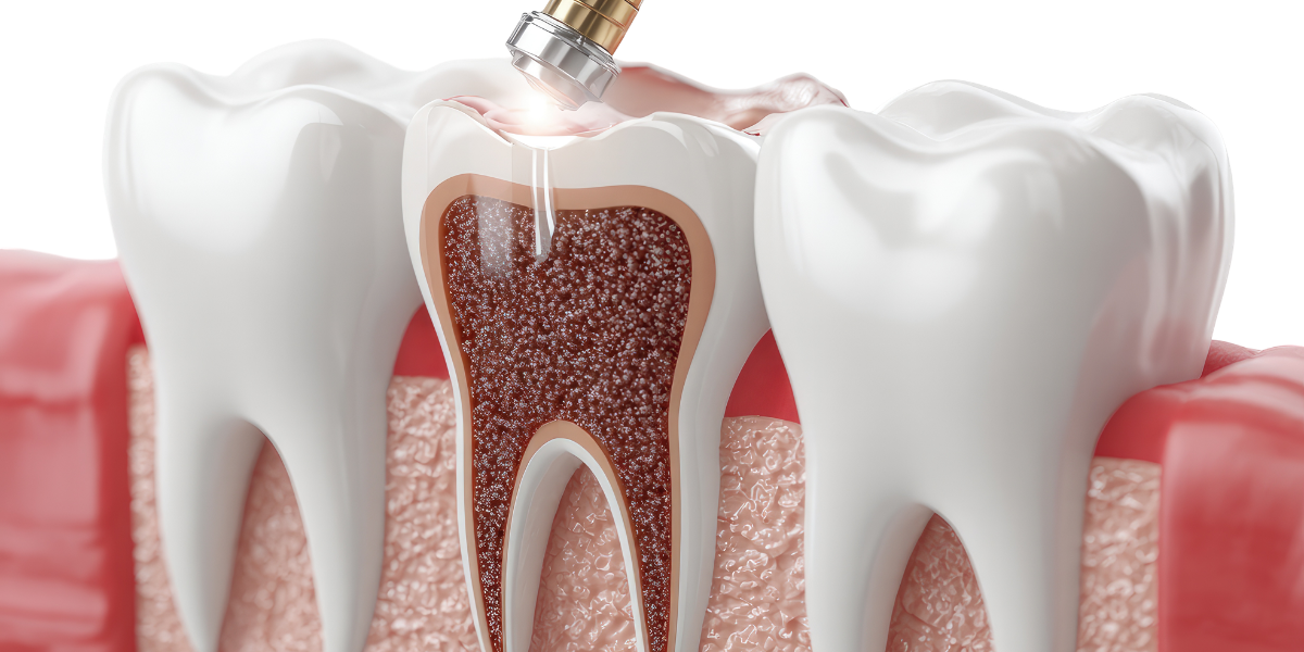 Natural Alternatives to Root Canals: What Actually Works