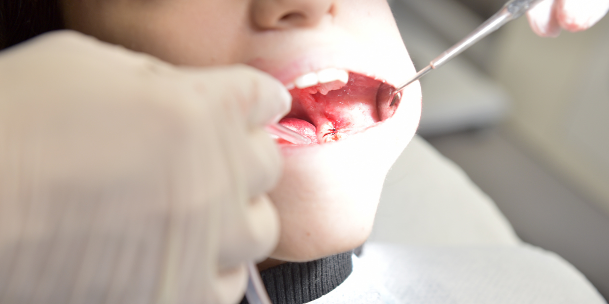 Overbite Getting Worse? Signs You Need Orthodontic Treatment