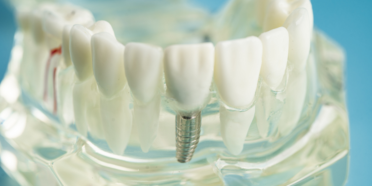 Top Reasons Your Dental Crown Might Hurt And What To Do About It