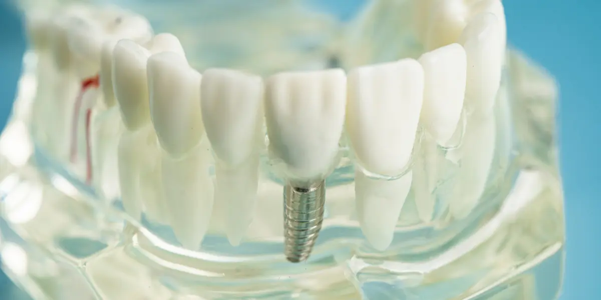 Top Reasons Your Dental Crown Might Hurt And What To Do About It