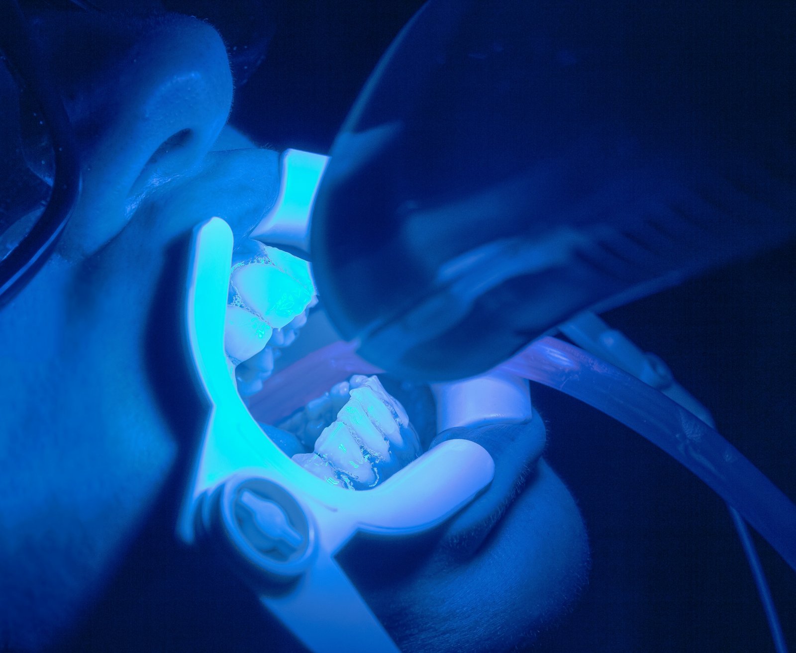 Zoom Whitening in Miami Beach at Cupo Dental