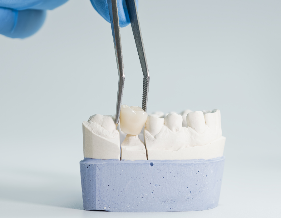 Who Needs a Dental Crown