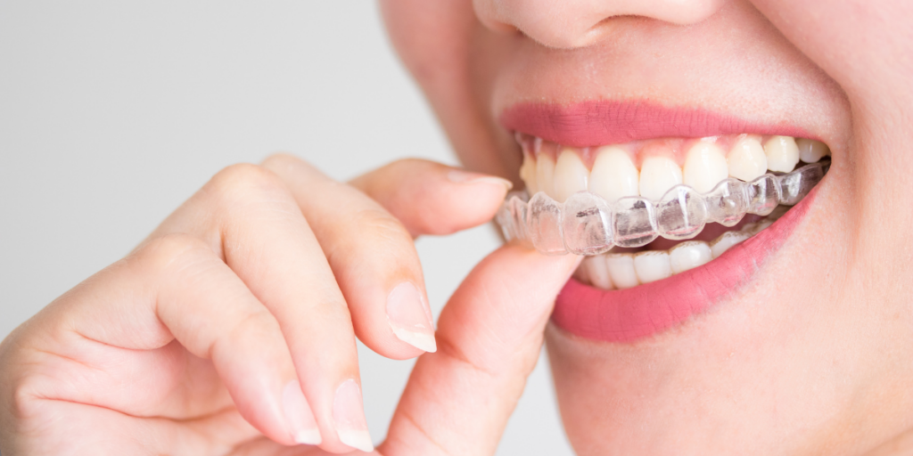 Can You Really Get Invisalign After Braces?
