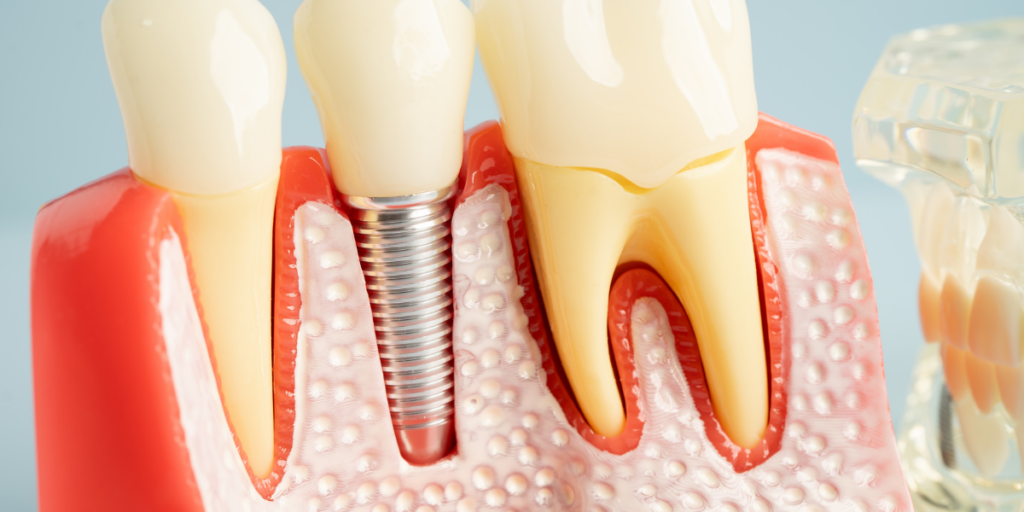 Who Is A Poor Candidate For Dental Implants