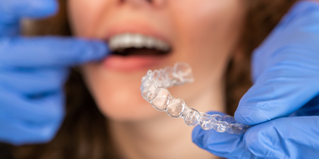 Why Patients Trust Cupo Dental for Invisalign After Braces in Miami Beach