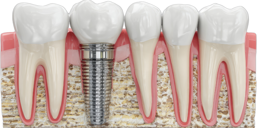 Why Bone Density Matters For Dental Implants