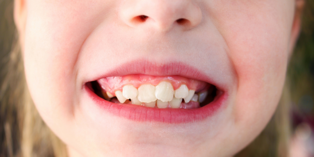 How Crooked Tooth Is Too Crooked For Invisalign?